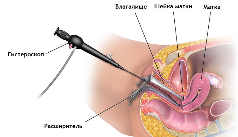 Гистероскопия